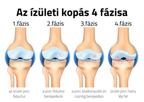 ízületi kopás diagram