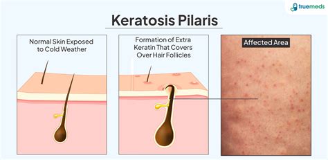 Keratosis pilaris a felkaron