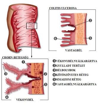 Crohn betegség tünetei