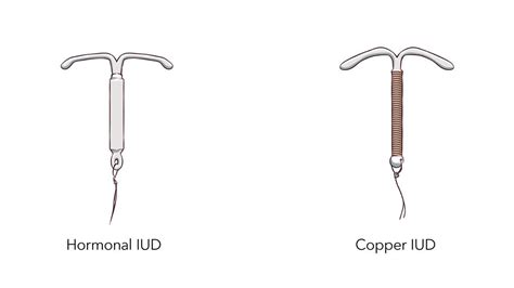 IUD felhelyezésének folyamata