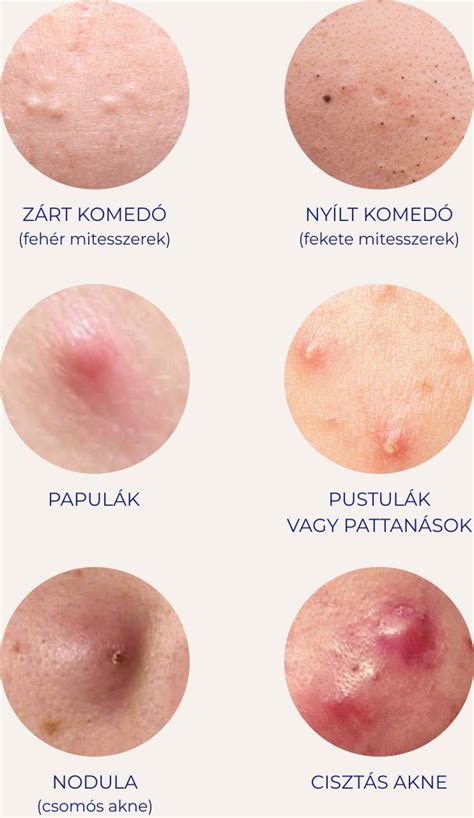 A bőrfaggyúmirigy működését és az akne kialakulását szemléltető diagram