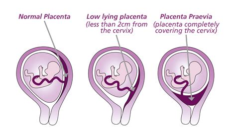 Placenta praevia illusztráció