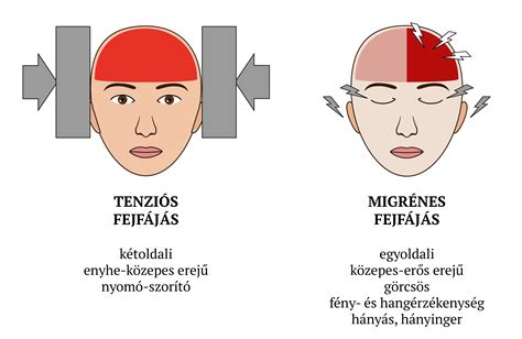 Migrénes fejfájás illusztráció