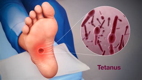 Tetanusz kórokozója, a Clostridium tetani