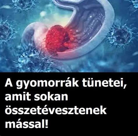A gyomorrák tünetei