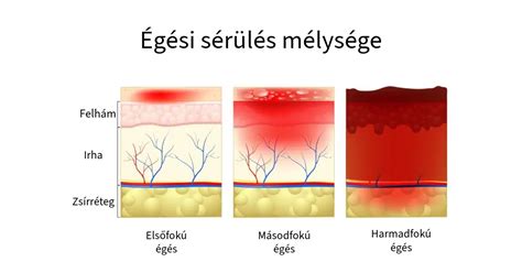 égési sérülések kezelése