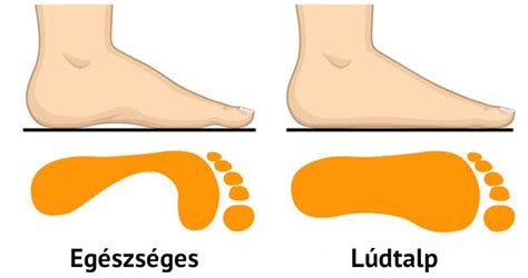 Gyermekkori lúdtalp megelőzése
