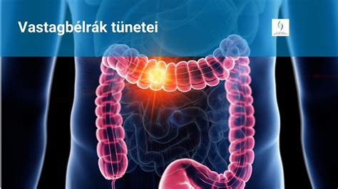 A vastagbél anatómiája és a daganatos elváltozások lehetséges helyei