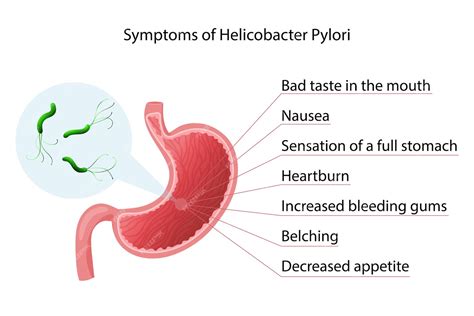 A Helicobacter pylori szerepe a gyomorbetegségekben