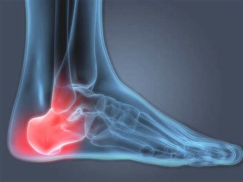 Sarkantyú (plantáris fasciitis)
