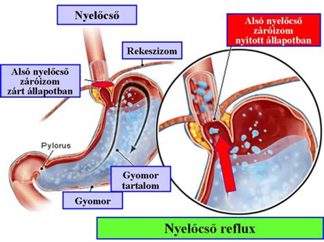 Reflux tünetek és a nyelőcső