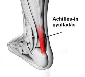 Az Achilles-ín anatómiai elhelyezkedése a lábszár hátsó részén