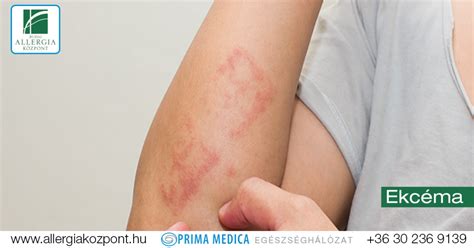 Az ekcéma tünetei a bőrön