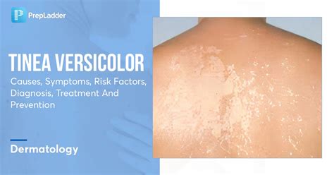 Tinea versicolor a háton