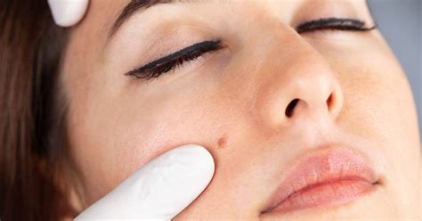 Vitiligo az arcon
