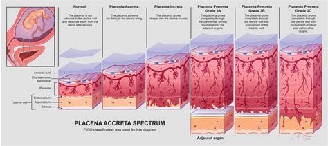 A placenta accreta spektrum típusai