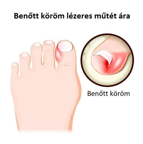 A benőtt köröm stádiumai és tünetei
