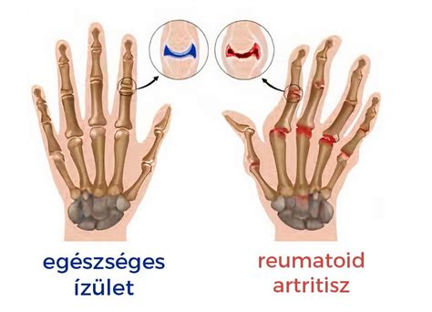 Reumás ízületi gyulladás hatása az ízületekre
