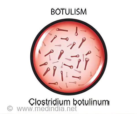 A Clostridium botulinum baktérium és a fertőzés terjedési útvonala