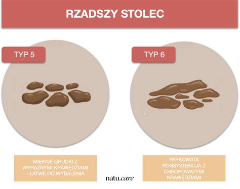 A széklet színeinek diagnosztikai jelentősége