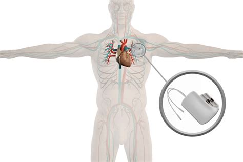 Pacemaker beültetés diagramja