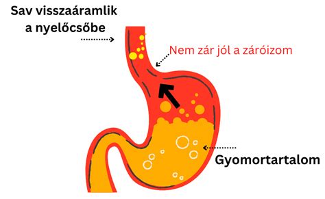 A gyomor és a nyelőcső közötti záróizom működését bemutató diagram