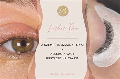 Trichinellózis okozta szemhéjduzzanat képe