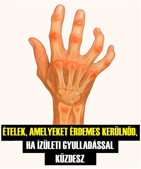 Élelmiszer piramis az ízületi gyulladás megelőzésére
