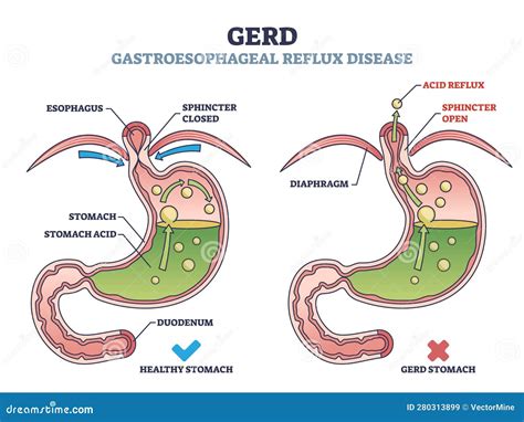 reflux mechanizmusa
