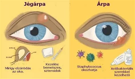 Árpa a szemhéjon - külső és belső