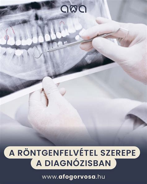 Térdkopás röntgenfelvétel