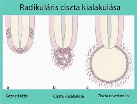 A mandulakövek kialakulása és tünetei