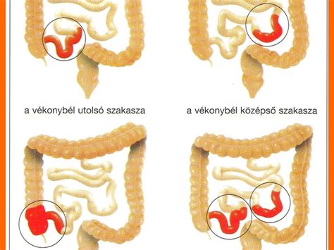 A gyulladásos bélbetegségek tünetei