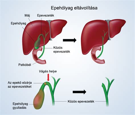 Epehólyag és epekő anatómiája