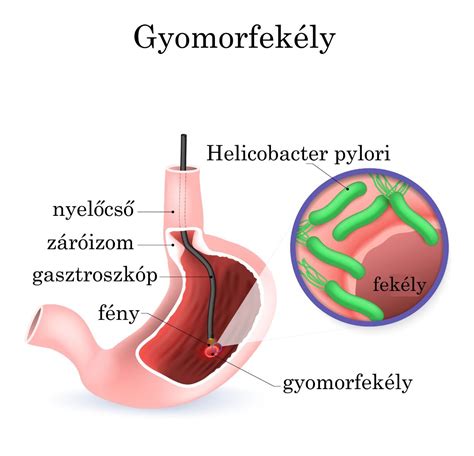 A gyomorfekély kialakulásának mechanizmusát bemutató diagram
