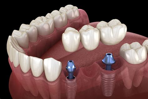 fogászati implantátum beültetésének folyamata