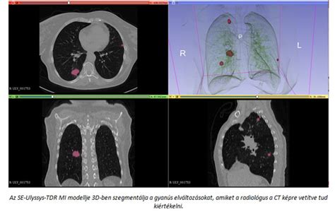 3D CT felvétel a fogazatról