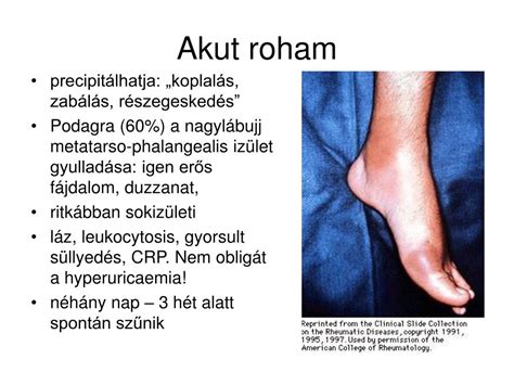 Köszvényes roham a nagylábujjon illusztráció