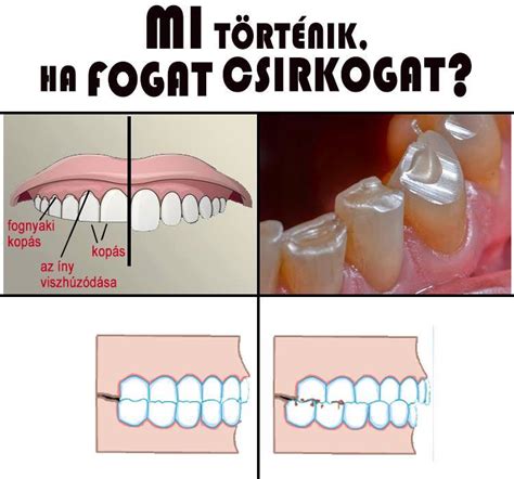 A fogcsikorgatás tünetei infografika
