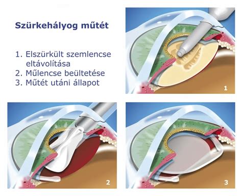 Arckontúrozás lépései