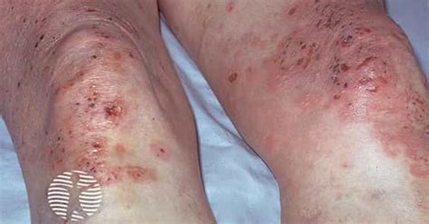 Dermatitis herpetiformis Duhring tünetei