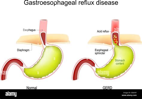 A reflux kialakulását magyarázó illusztráció
