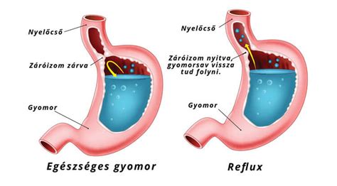 A reflux gyakori tünetei