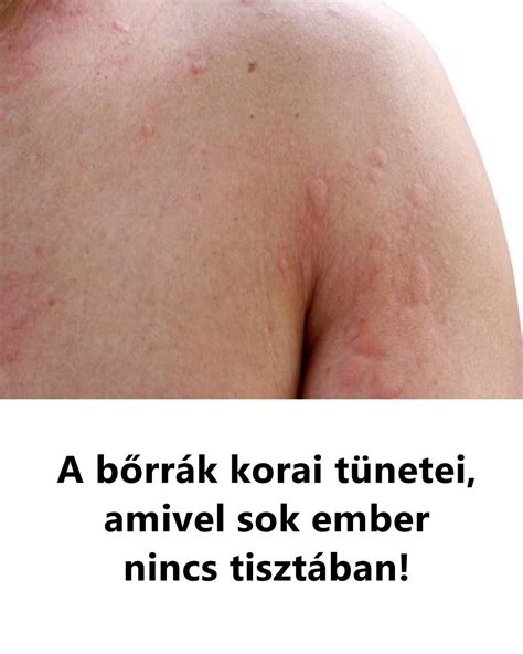 bőrrák megelőzése