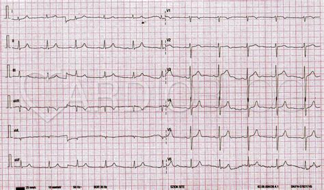 EKG eltérések magas káliumszint esetén