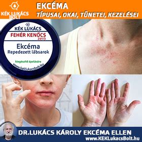 Ekcéma tünetei diagram