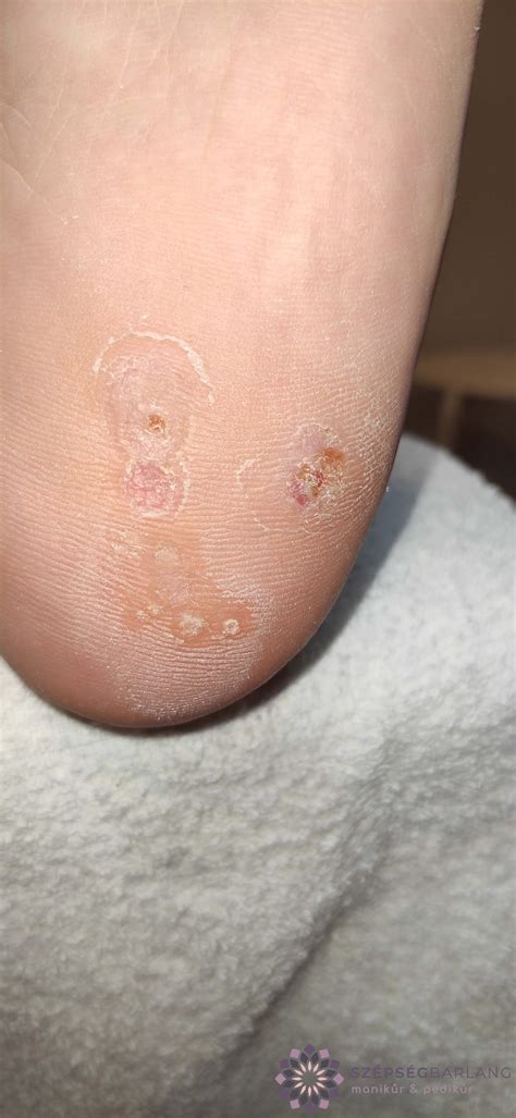 Infografika a HPV vírus és a szemölcsök kapcsolatáról