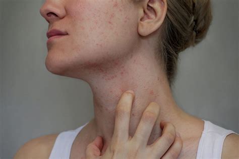 Allergiás reakciók a bőrön és a légutakban