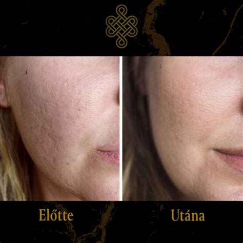 Carbon Peel kezelés előtt és után